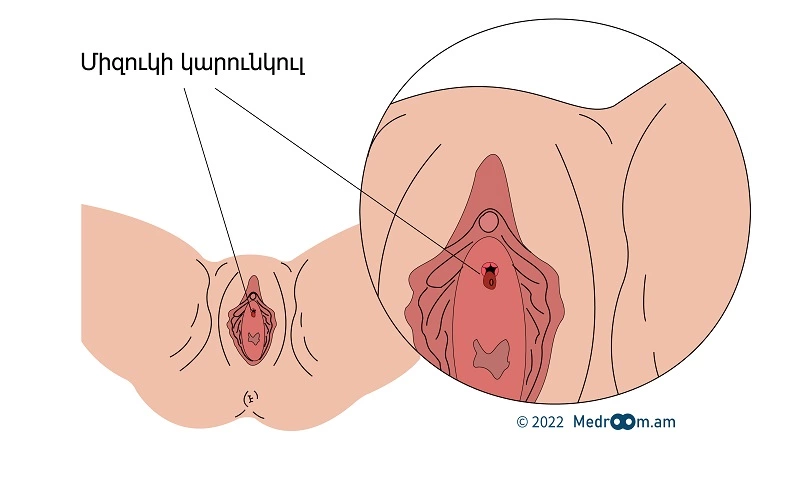 Միզուկի կարունկուլ