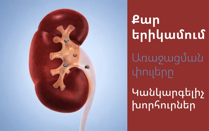 Երիքամի քար, երիկամի քարի կանխարգելում, երիկամի քարի առաջացման փուլերը